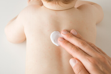 Mother fingers applying white medical ointment on infant bare back. Red rash on skin. Allergy from...