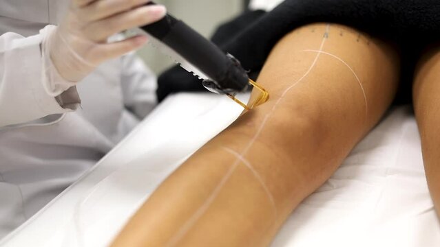 Beautician salon laser hair removal procedures. Video footage closes up the legs of female clients getting pulses of laser light destroying the hair follicle.