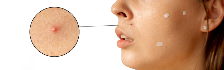 Skin of face of young woman is affected by chickenpox, acne defects