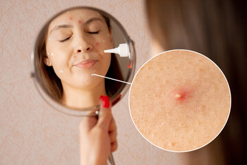 Close up woman applying cream on skin ill with chickenpox - obrazy, fototapety, plakaty