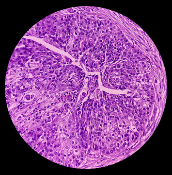 High grade mucoepidermoid carcinoma of parotid cyst. Microscopic show parotid tissue, features of mucoepidermoid carcinoma, reactive changes. Histology. Parotid cancer.