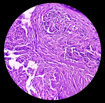High grade mucoepidermoid carcinoma of parotid cyst. Microscopic show parotid tissue, features of mucoepidermoid carcinoma, reactive changes. Histology. Parotid cancer.