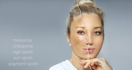Dark spots, freckles,hyperpigmentation(melasma or chloasma),concept - skin lightening, skin...