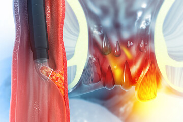 Haemorrhoids (piles) on scientific background. surgery for bleeding haemorrhoids with external thrombosis. 3d illustration