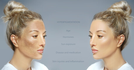 Dark spots, freckles,hyperpigmentation(melasma or chloasma),concept - skin lightening, skin...