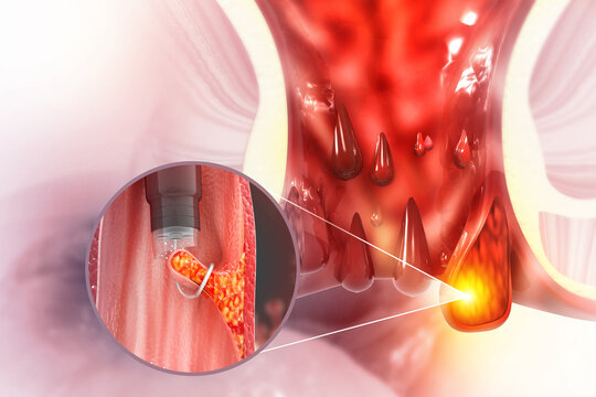 Haemorrhoids (piles) on scientific background. surgery for bleeding haemorrhoids with external thrombosis. 3d illustration