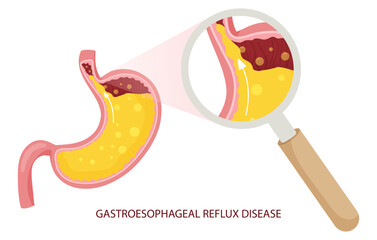 Gastroesophageal reflux disease illustration under magnifying glass