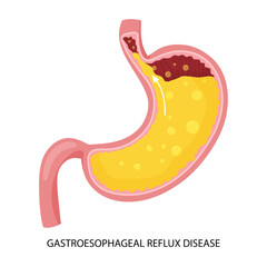 Gastroesophageal reflux disease and heartburn illustration