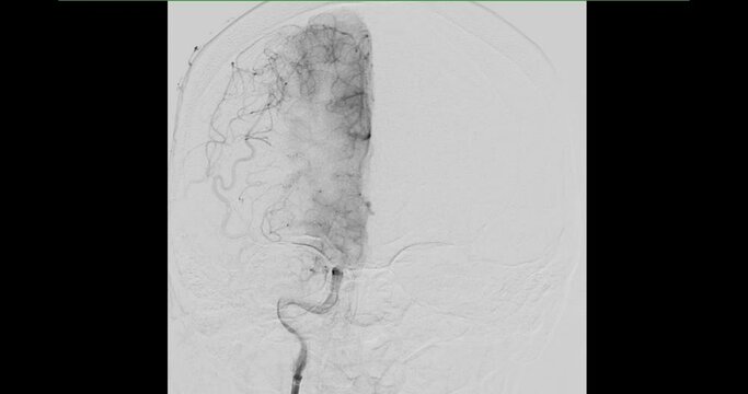 Cerebral angiogram  for diagnosis  cerebral artery aneurysms and cerebral artery disease such as atherosclerosis (plaque).