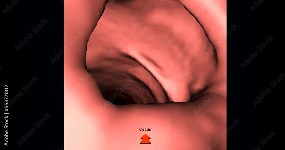 Aufkleber ct colonography 3d rendering with abdomen coronal view showing intra colon for screening colorectal 