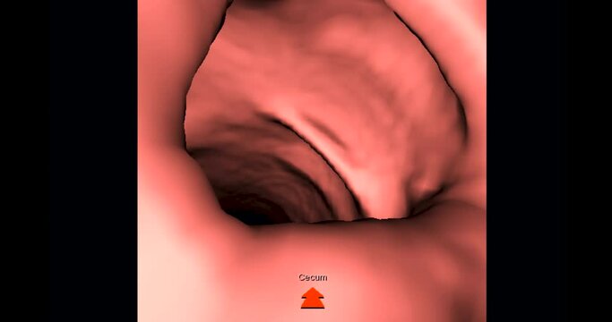CT colonography  3D rendering with Abdomen coronal view  showing intra colon for screening colorectal cancer. Check up Screening cancer of colon.