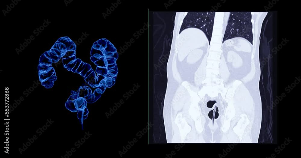 Aufkleber ct colonography 3d rendering with abdomen coronal view showing intra colon for screening colorectal 
