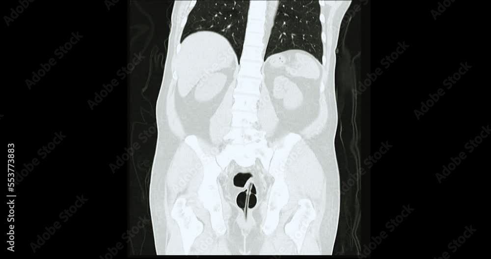 Poster ct colonography coronal view showing intra colon for screening colorectal cancer. check up screening