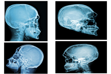 Collection of  skull . front view . x-ray Lateral view skull . isolated background 