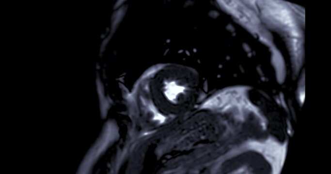 MRI heart or Cardiac MRI ( magnetic resonance imaging ) of heart in Short axis view showing heart beating for detecting heart disease.