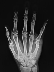 x ray of hand
