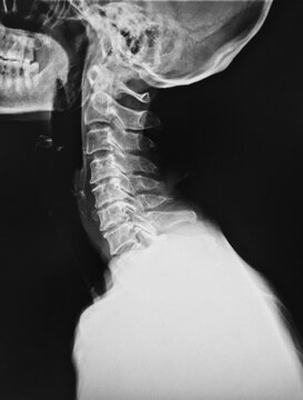 x ray image of spine