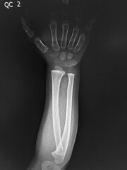 x ray of hand