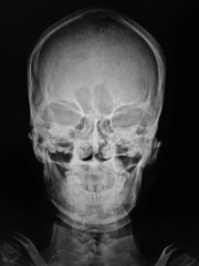 Film x-ray of normal human skull 