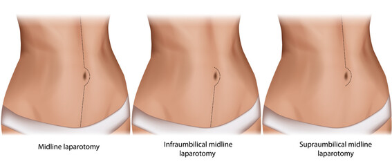 Abdominal midline incision. Incision sites for types of midline laparotomies. Midline laparotomy, Infraumbilical and Supraumbilical midline laparotomy. - obrazy, fototapety, plakaty
