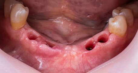 hybrid ceramic bridge on implants