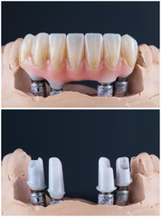 hybrid ceramic bridge on implants