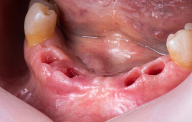hybrid ceramic bridge on implants