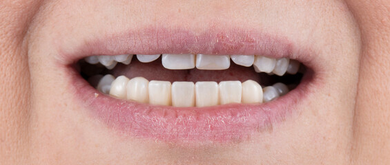 hybrid ceramic bridge on implants
