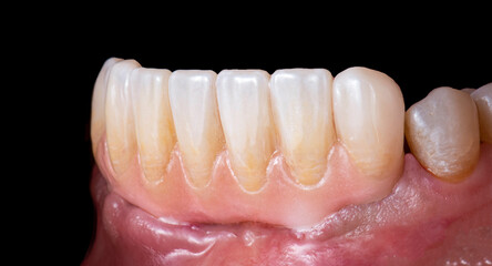 hybrid ceramic bridge on implants