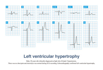 Sometimes, left ventricular hypertrophy with tall T waves is easily misdiagnosed as hyperkalemia and hyperacute T waves, and ECG needs to be carefully identified in combination with clinic.