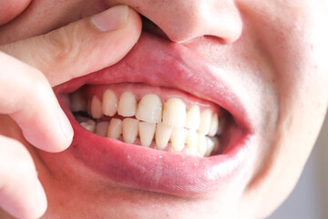 Close up dirty teeth should be treated with caries
