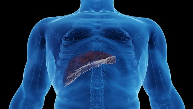 3D medical animation of a man's cirrhotic liver