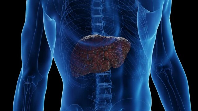 3D medical animation of a man's cirrhotic liver
