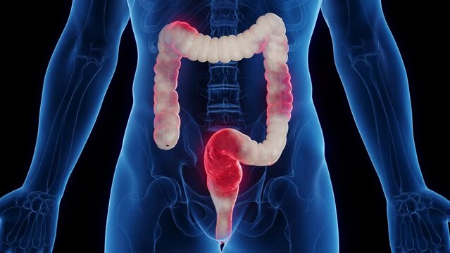 3D medical animation of a man's inflamed colon