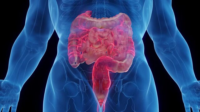 3D medical animation of a man's intestines affected by crohn's disease