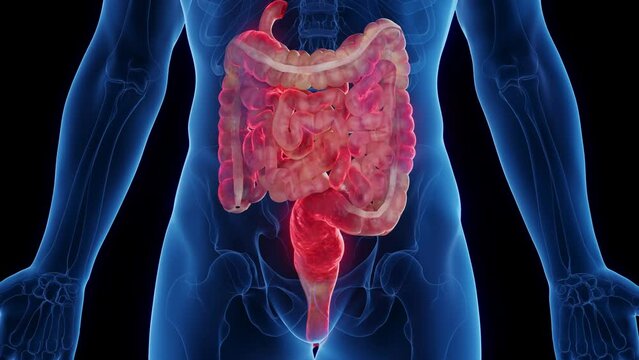 3D medical animation of a man's intestines affected by crohn's disease