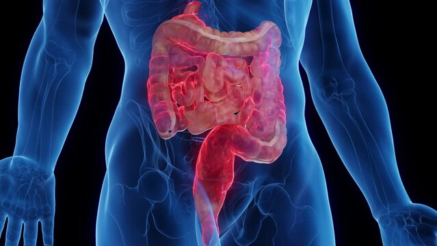 3D medical animation of a man's intestines affected by crohn's disease