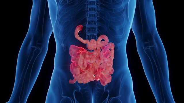 3D medical animation of a man's inflamed small intestine