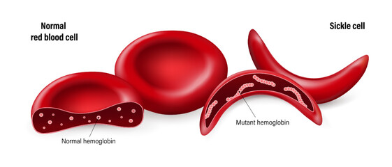Sickle cell disease. Normal red blood cells and sickled red blood cells. Normal hemoglobin and mutant hemoglobin.