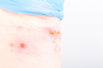 chemical burn on the wrist skin with hydroxide sodium acid, by striping paint from wood furniture. Household accident, because of blue gloves to sharp