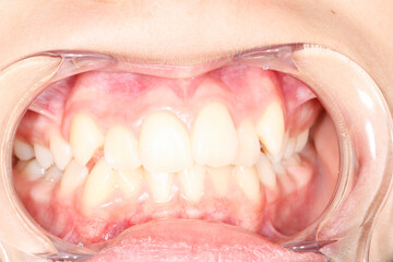 Intra-oral picture of teeth and gum in the smile mouth oral care. Bacteria, dental plaque is the...