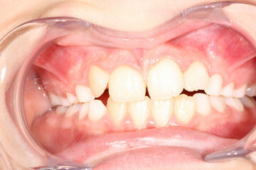 Intra-oral picture of teeth and gum in the smile mouth oral care. Bacteria, dental plaque is the...