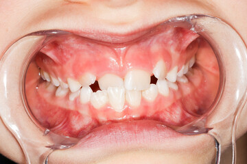 Intra-oral picture of teeth and gum in the smile mouth oral care. Bacteria, dental plaque is the...