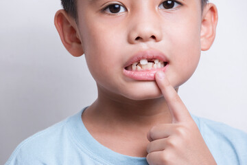 asian boy face looking at tooth and showing teeth behind on white background.