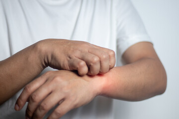 Man scratching his hand. Medical concept.