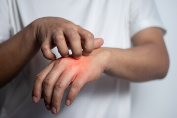 Man scratching his hand. Medical concept.