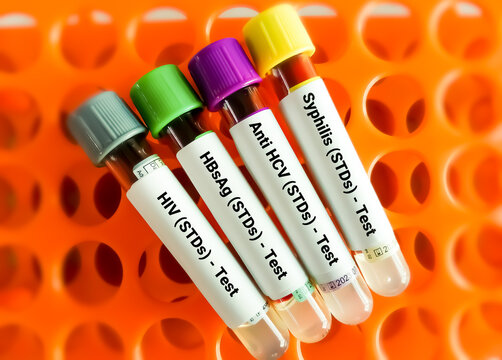 Close view of blood samples for sexually transmitted infection (STI) test, STD. HIV, SYPHILIS, HEPATITIS C, HEPATITIS B.