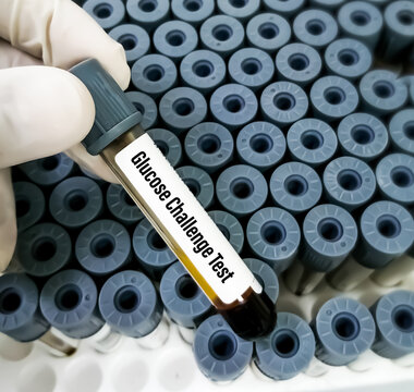 Blood Sample For Glucose Challenge Test, Also Known As One-hour Glucose Tolerance Test. Screening Test For Gestational Diabetes That Develops During Pregnancy.