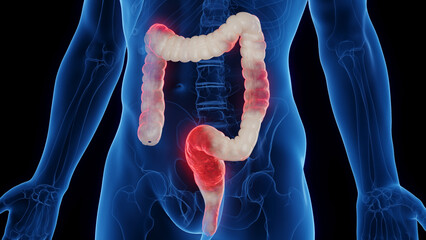 3D medical illustration of a man's inflamed colon - 554402494