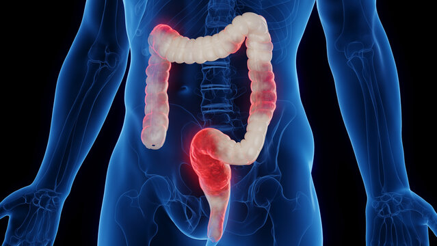 3D medical illustration of a man's inflamed colon